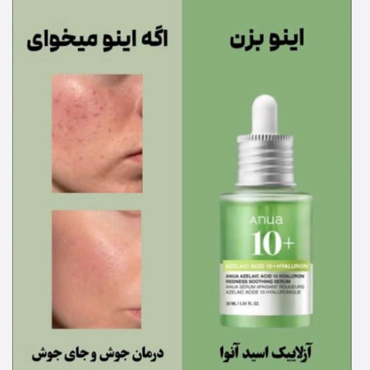 سرم آنوا مدل Azelaic Acid 10% + Hyaluron حجم 30 میلی لیتر